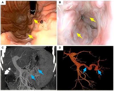 Refractory massive chylothorax following robot-assisted laparoscopic splenectomy with pericardial devascularization treated with trans-jugular intrahepatic portosystemic shunt: a case report